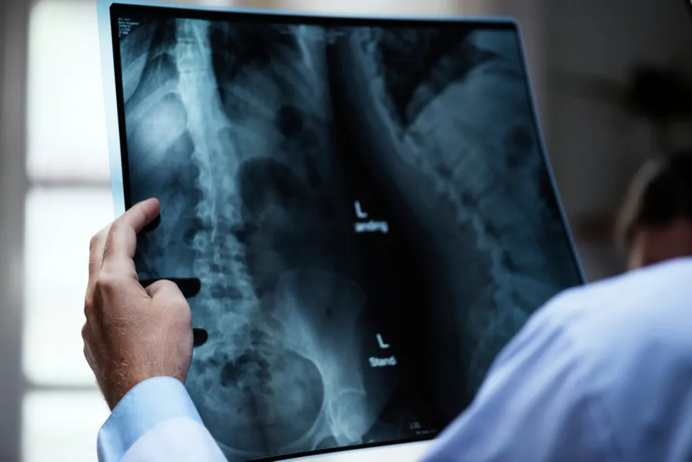 Is Scoliosis a Disability? What You Need to Know
