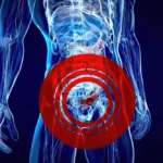 Chirurgie robotică a herniei