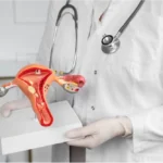 Adenomyosis: Symptoms, Causes, and Treatment Options
