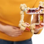 What Causes Crohn’s Disease